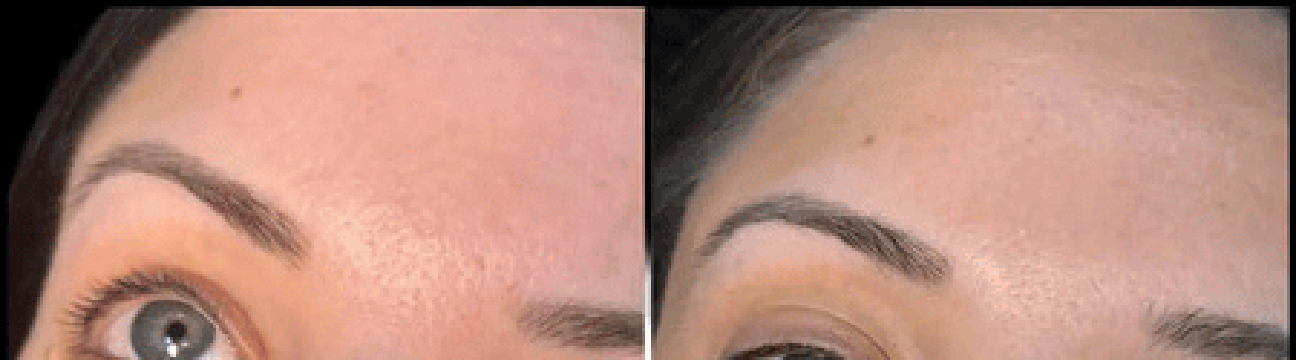 Dermal Fillers